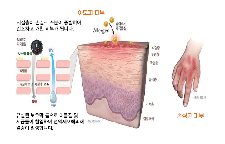 아토피 피부염